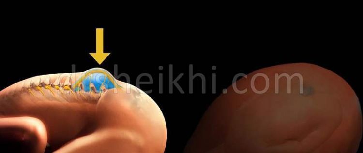 بیماری اسپینابیفیدا نوزادان