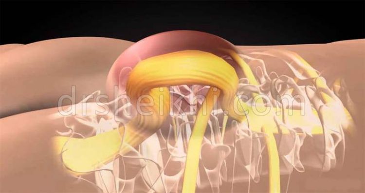 بیماری اسپاینا بیفیدا و راههای درمان
