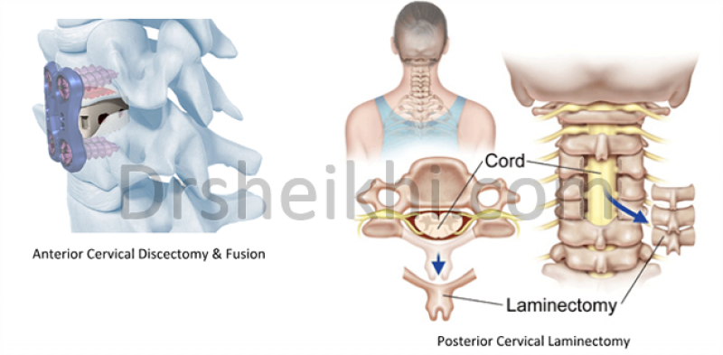 جراحی لامینکتومی گردن