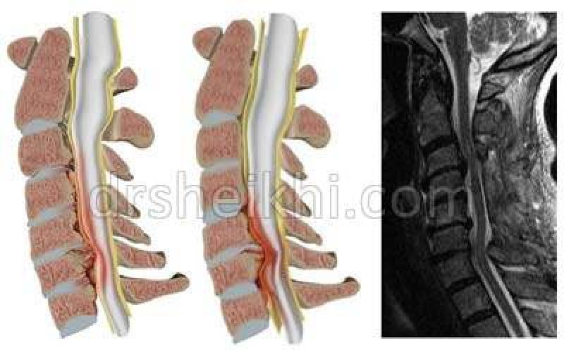 تنگی کانال نخاعی