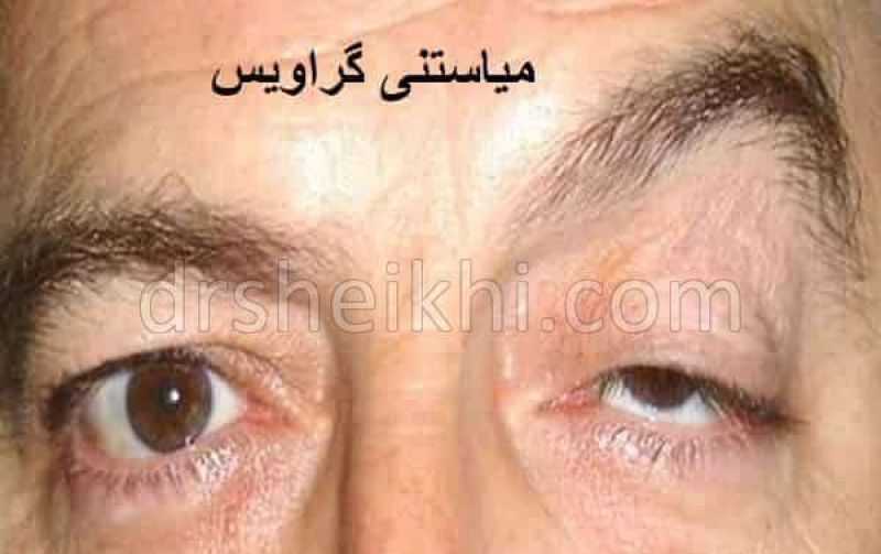  سندروم پارانئوپلاستیک