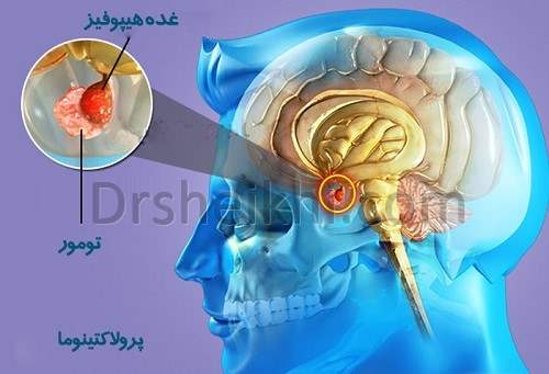 تومور هیپوفیز