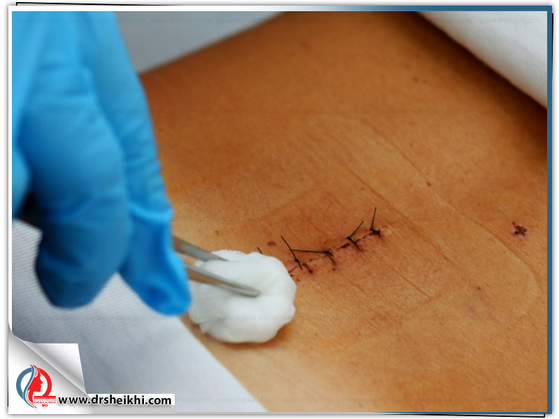 Sutures-after-disc-surgery