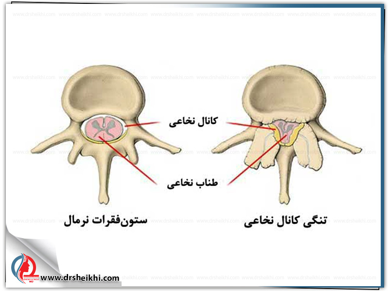 Spinal-canal-stenosis