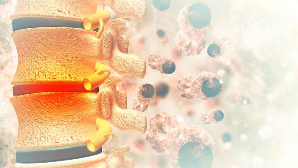 متاستاز ستون فقرات
