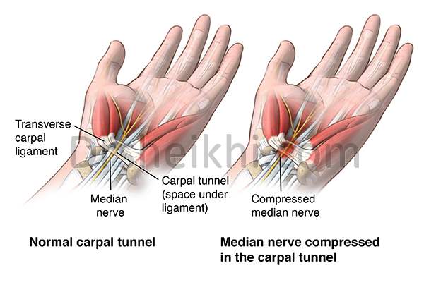 جراحی سندروم تونل کارپال