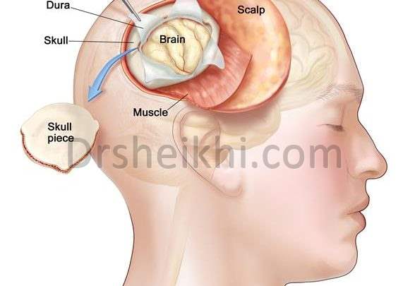 جراحی کرانیوتومی