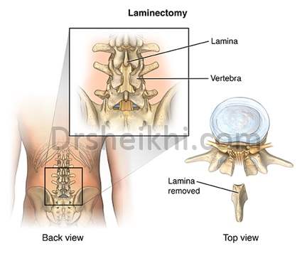 جراحی لامینکتومی دیسک کمر