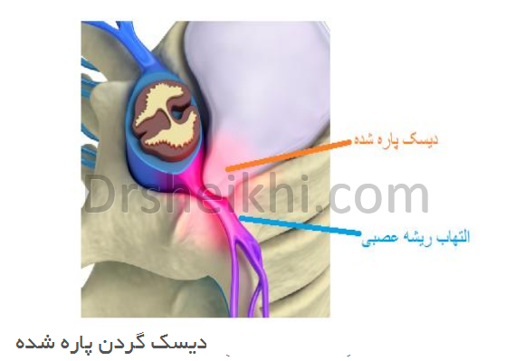 جراحی دیسک گردن