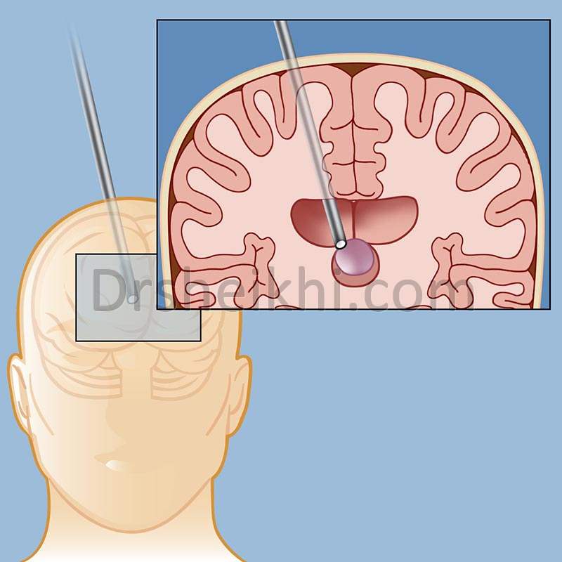 جراحی هیدروسفالی