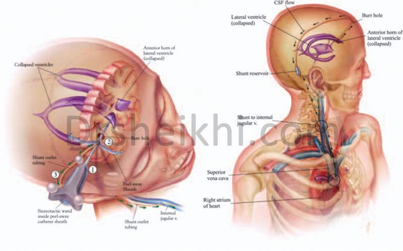 جراحی شانت گذاری در هیدروسفالی