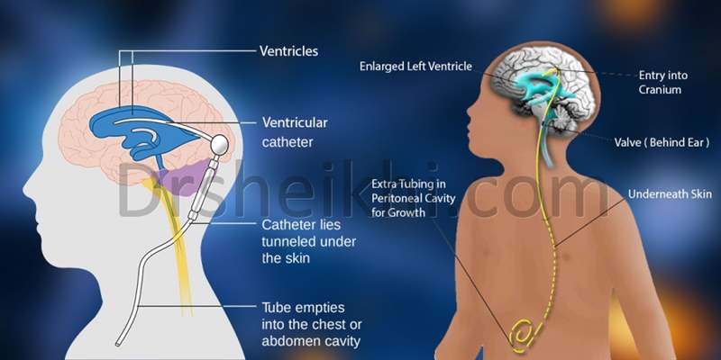 جراحی شانت گذاری برای بیمار هیدروسفالی