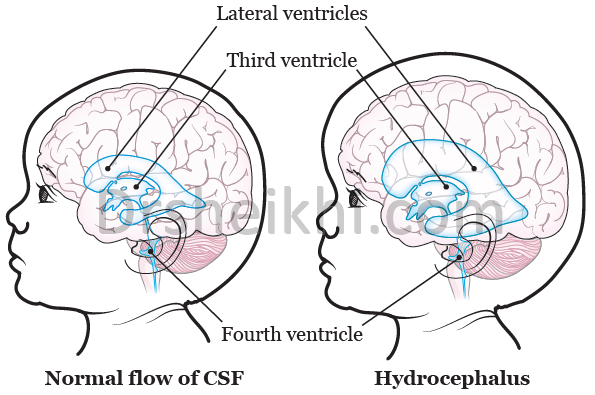 هیدروسفالی ماردزادی