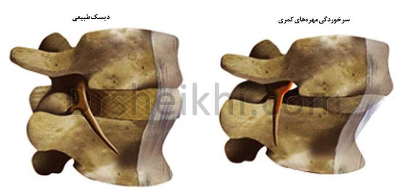 جراحی لغزندگی مهره کمر