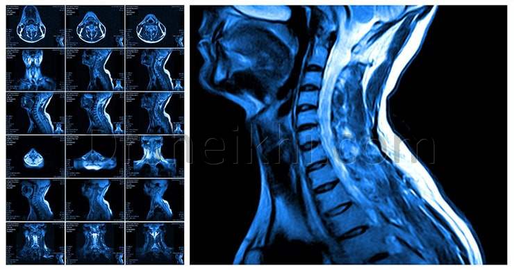 تشخیص دیسک گردن