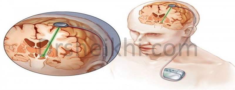 جراحی تحریک الکتریکی در جراحی درد