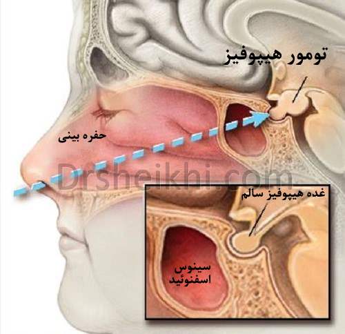 جراحی آندوسکوپی تومور هیپوفیز