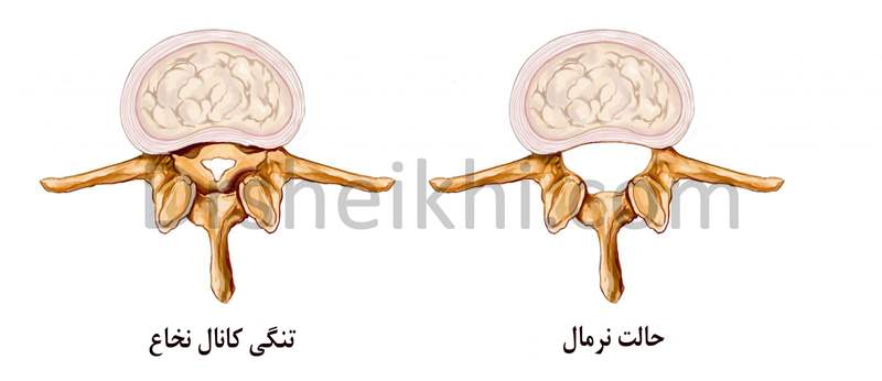 تنگی کانال نخاعی