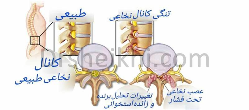 تنگی کانال نخاعی