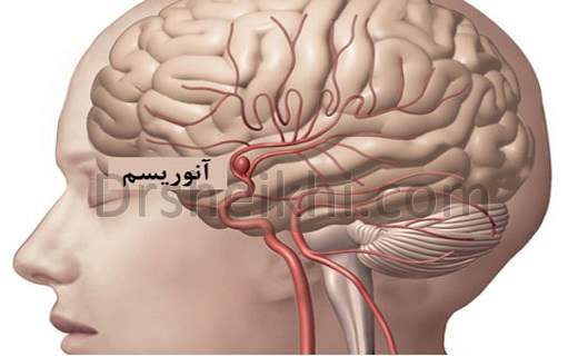 آنوریسم مغزی