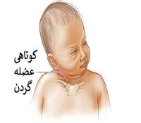 سندروم کلیپل فایل یا کوتاهی گردن نوزادان