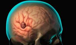آبسه مغزی چیست؟