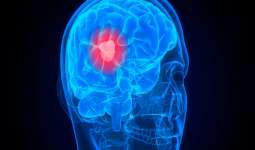راههای درمان و شناسایی تومور مننژیوم مغزی