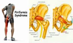 راههای درمان و تشخیص سندروم پیریفورمیس