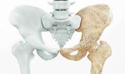 تفاوت بین کاهش تراکم استخوان و پوکی استخوان چیست؟