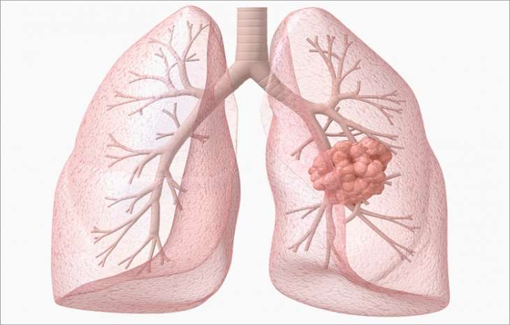 تومورهای متاستاتیک ریه و راههای درمان