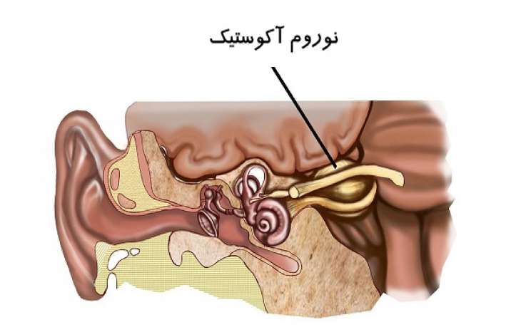 از علائم تا راههای درمان تومور نورینوم آکوستیک