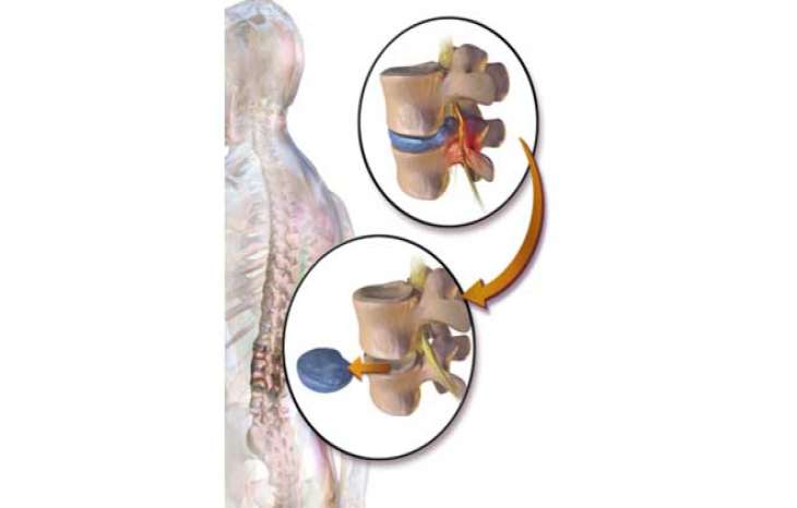 جراحی دیسککتومی ستون فقرات 