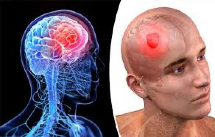 انواع تومورهای مغزی بدخیم