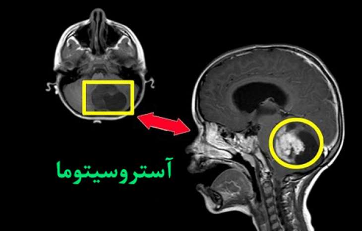 تومور آستروسیتومای آناپلاستیک مغز