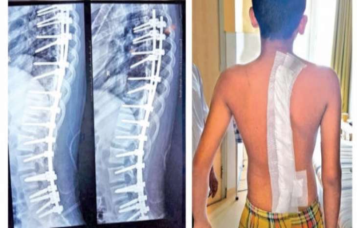 مراقبت های پس از جراحی اسکولیوز