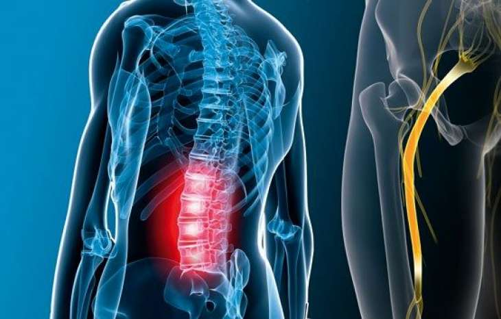 علائم دیسک کمر در پاها