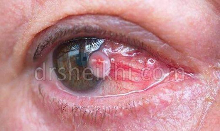 علائم تومور کاسه چشم