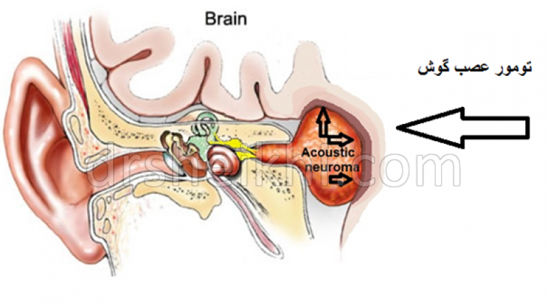 تومور عصب گوش