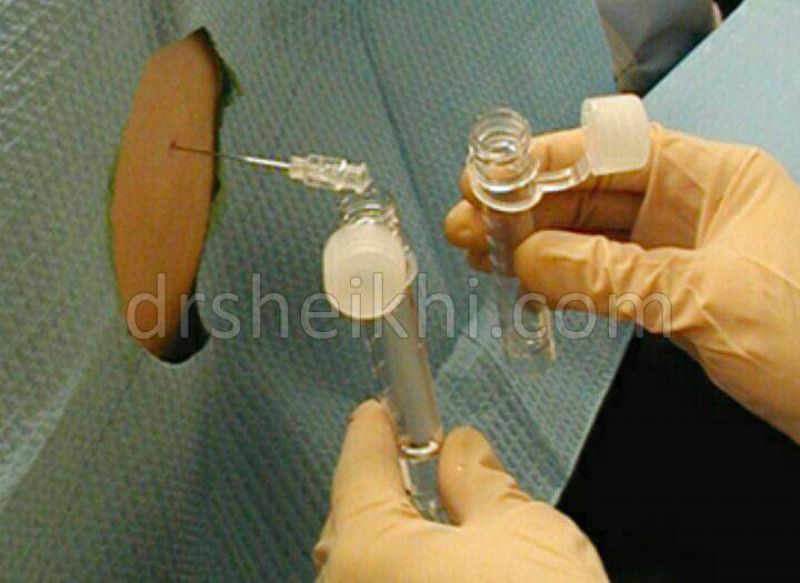 نمونه برداری از مایع مغزی و نخاعی بوسیله پونکسیون کمری